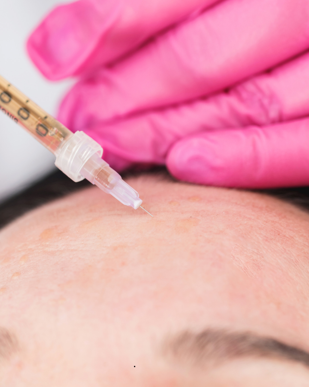 mesoterapia